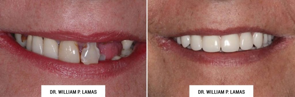 All-on-4 Dental Implants Before & After Photo - William P. Lamas, DMD - Periodontics & Dental Implants. Address: 2645 SW 37th Ave Suite 304, Miami, FL 33133 Phone: (305) 440-4114